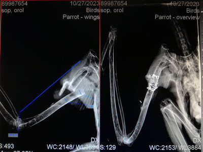 Rentgen, vľavo ramenná osť pred zákrokom, vpravo po stabilizácii vnútrodreňovým implntátom zo zedexu a drátenými cerklážami