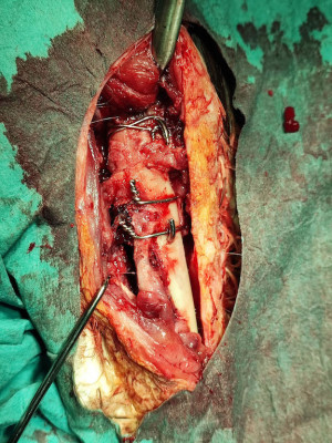 pohľad do operačného poľa, vidno drátené slučky stabilizujúce implantát. Ten už je vo vnútri kostí.