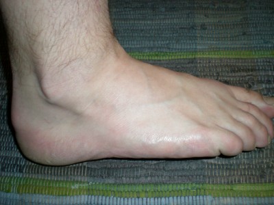 pro srovnání zdravá noha